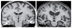IRM montrant l'atrophie de l'hippocampe dans le cadre d'une maladie neuro-dégénérative type maladie d'Alzheimer